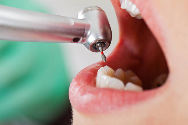 Best Dentist for Tooth Abscess  in Hillsborough, CA